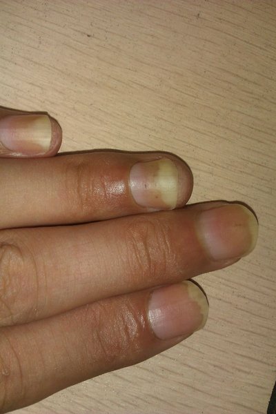 惠安縣治灰指甲皮膚專科