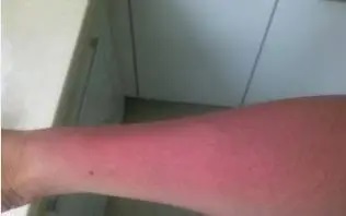面部皮炎困擾，你需要了解這些